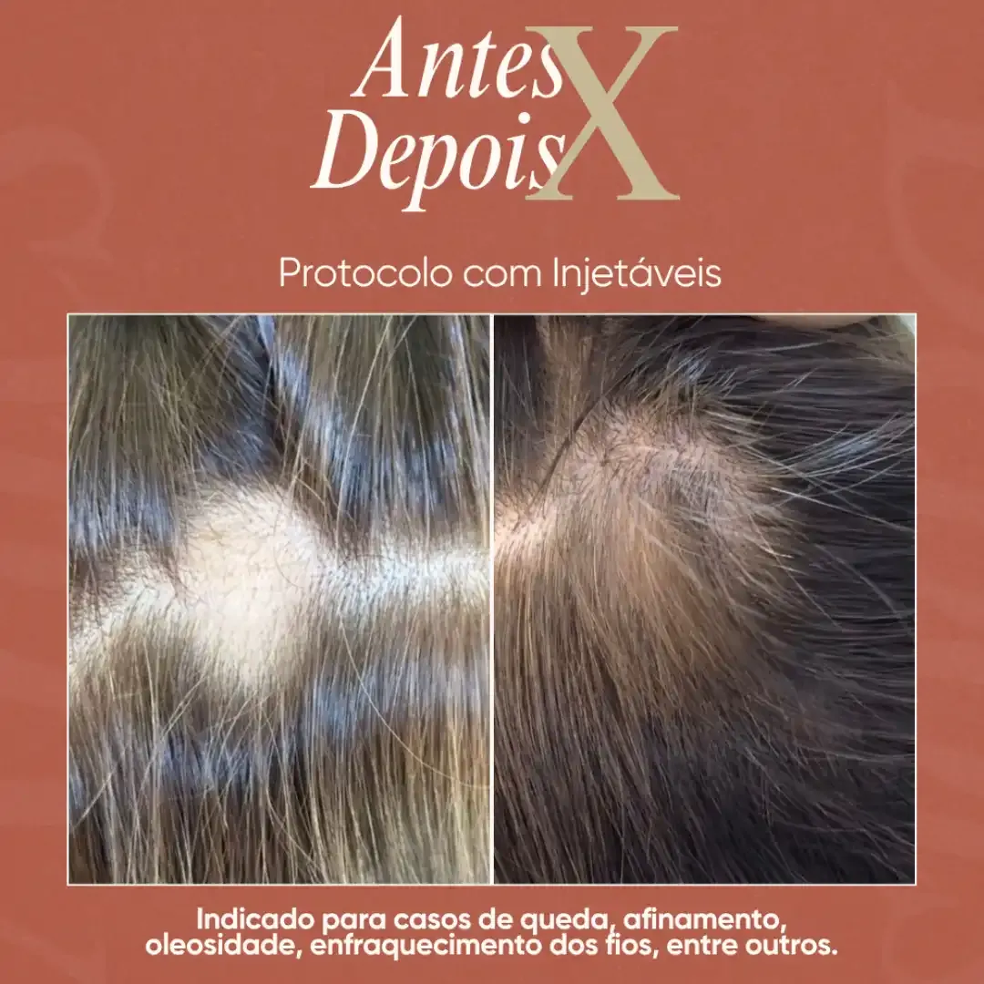 Tratamento de eflúvio telógeno após uso de caneta emagrecedora — antes e depois