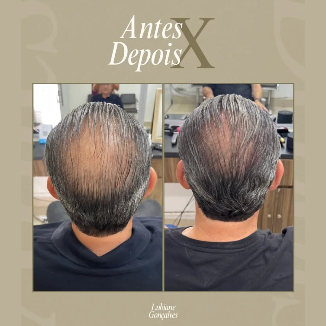 Antes e depois de tratamento de afinamento capilar em Brasília