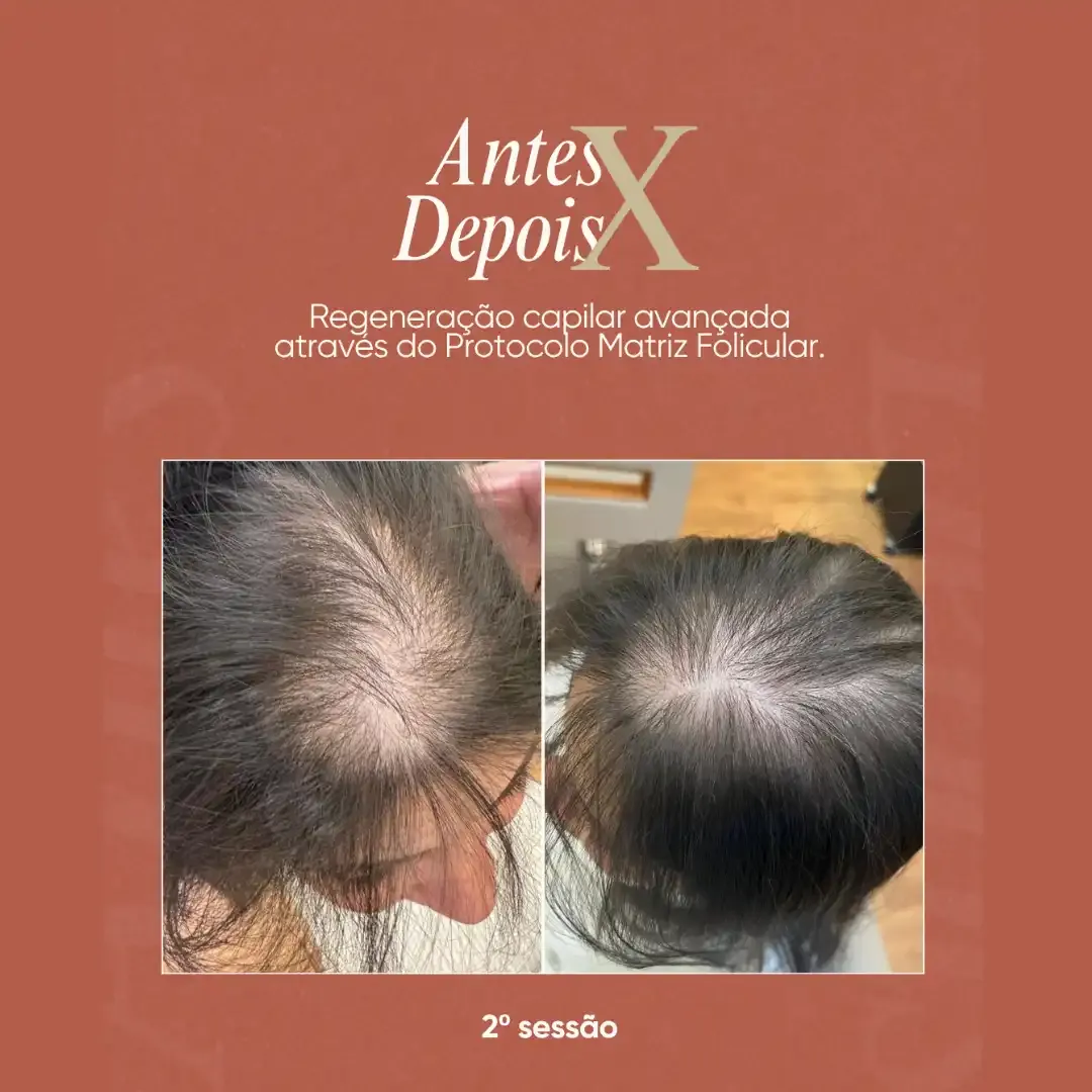 Resultado de tratamento capilar feminino em clínica de tricologia em Brasília
