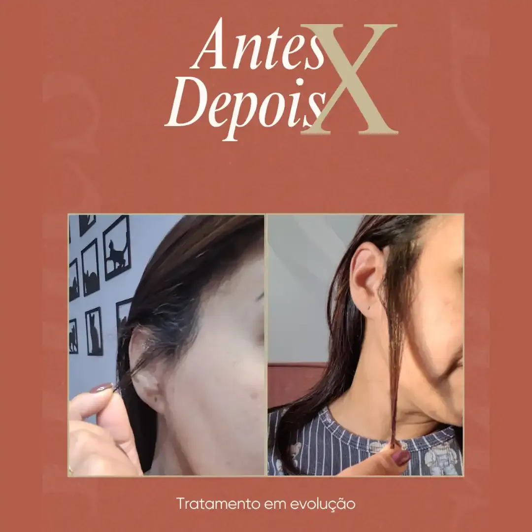 Antes e depois de queda de cabelo feminina tratada por tricologista em Brasília