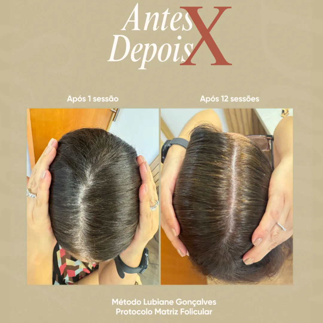Antes e depois de tratamento de calvície feminina com tricologista