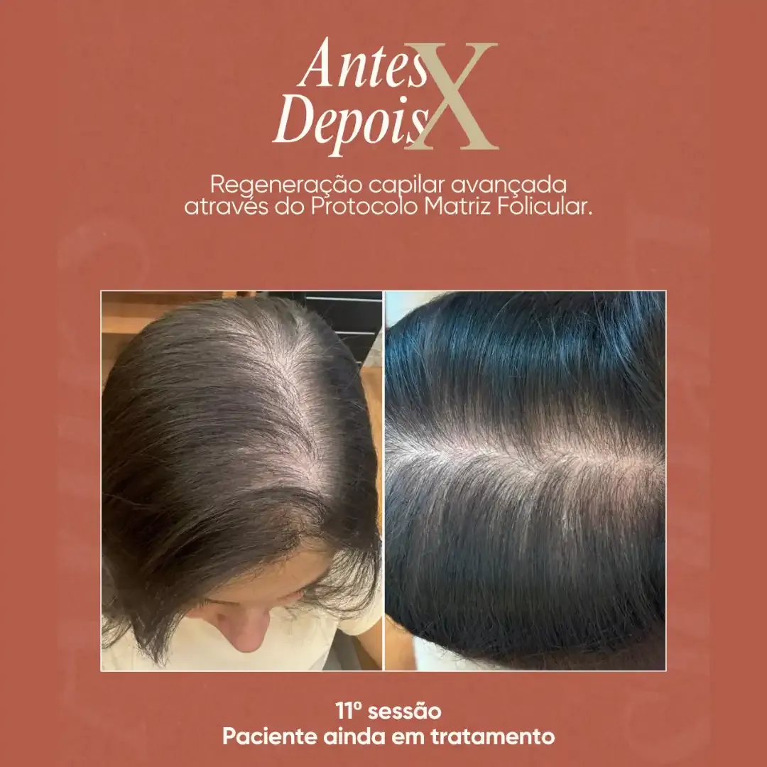 Antes e depois de tratamento de alopecia androgenética