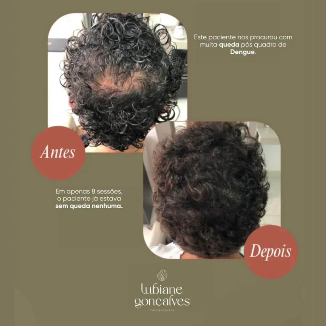 Antes e depois de queda de cabelo pós-dengue e alopecia