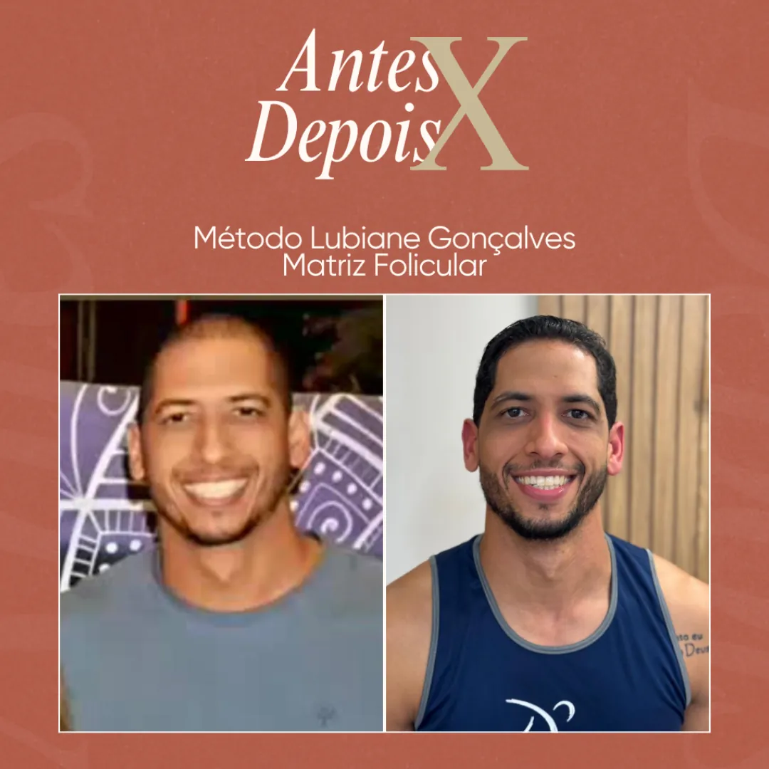 Antes e depois do protocolo Matriz Folicular após 12 sessões